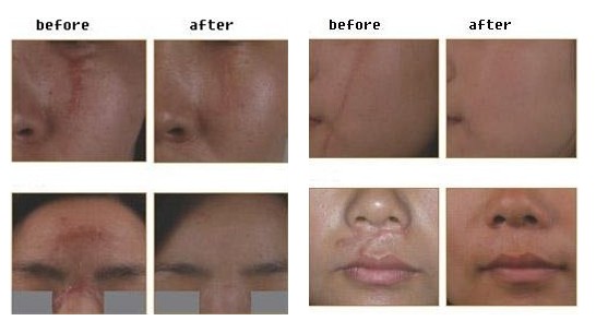 Co2 Fractional Laser Skin Resurfacing Equipment Built-in Circulating Water Cooling