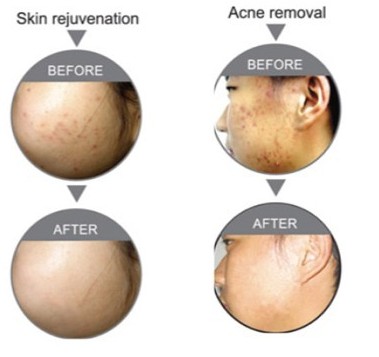 Co2 Fractional Laser Skin Resurfacing Equipment Built-in Circulating Water Cooling