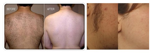 Intense Pulsed Light Therapy SHR Hair Removal Equipment IPL with Filters 430 / 530 / 640 ~ 1200nm