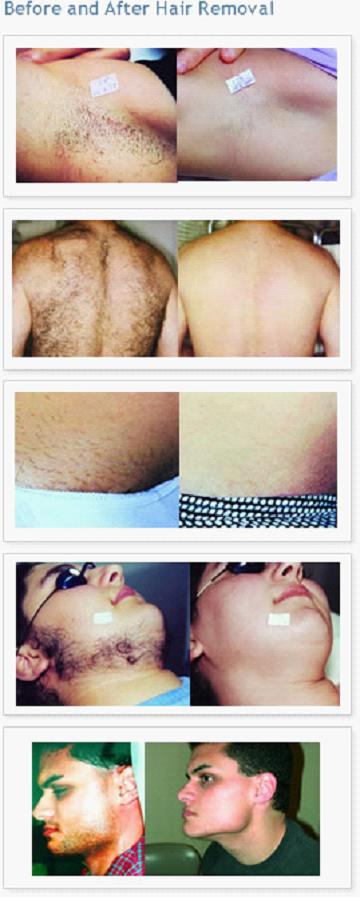 Intense Pulsed Light Therapy SHR Hair Removal Equipment IPL with Wavelength 430 / 530 / 640 ~ 1200nm