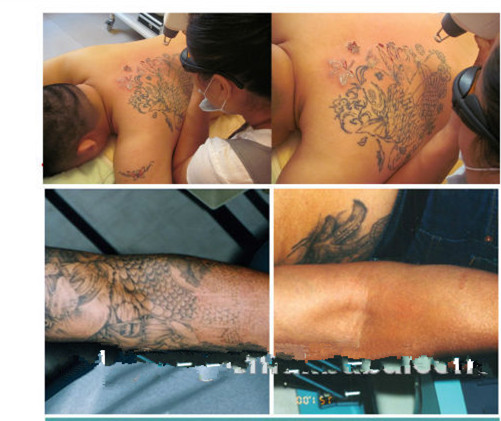 q switched nd yag laser tattoo removal 2 yag bars with ce approval q switched nd yag laser tattoo removal 2 yag bars with ce approval