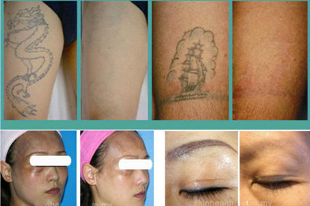q switched nd yag laser white grey certificate ce tattoo q switched nd yag laser white grey certificate ce tattoo