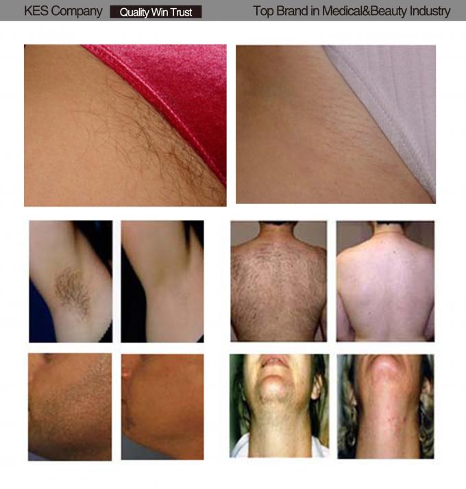 IPL SHR Hair Removal Machine with 650 - 950nm wavelength , 15 x 50mm spot size