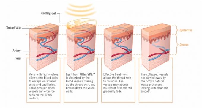 Wrinkle Removal IPL Hair Removal Machines With Variable Pulse Technology