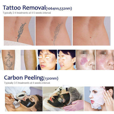 Q Switch Laser Tattoo Removal Machine 1064 532nm ND YAG Laser