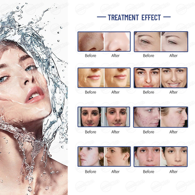 Noninvasive Hydro Oxygen Facial Machine Skin Treatment