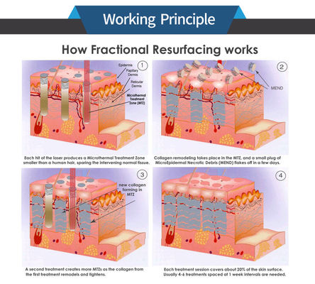 Scars Removal CO2 Fractional Laser Machine