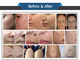 Scars Removal CO2 Fractional Laser Machine