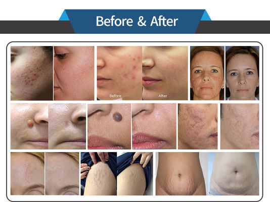 Scars Removal CO2 Fractional Laser Machine